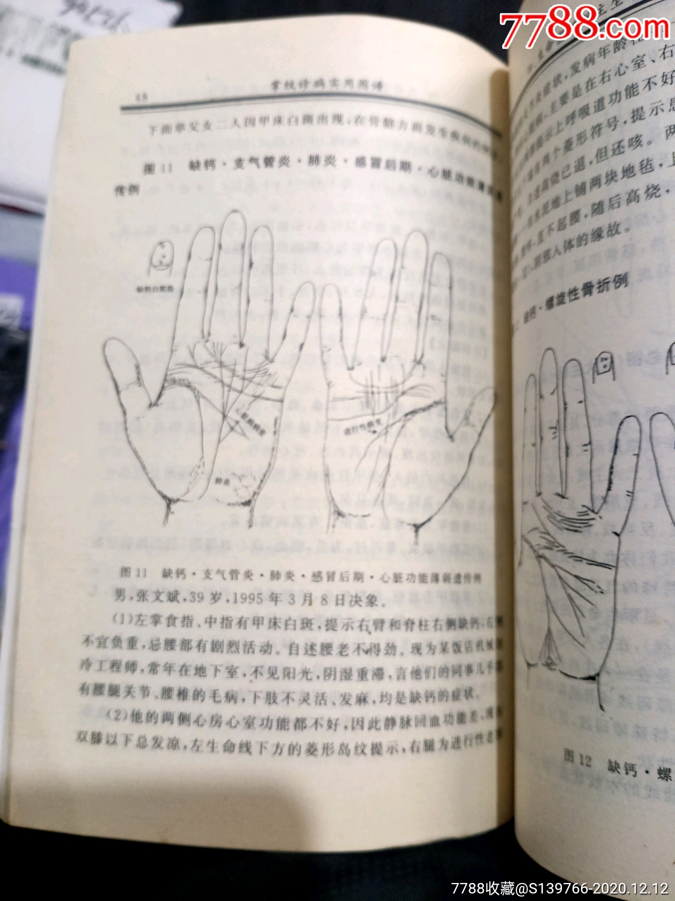 掌纹诊病实用图谱